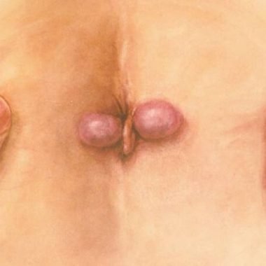Геморрой у женщин: симптомы, фото, лечение геморроя в домашних условиях
