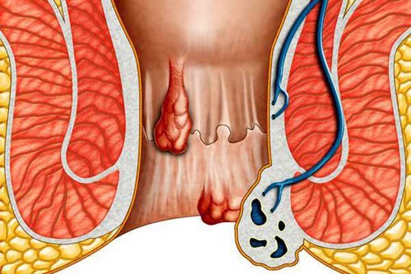 Может ли геморрой рассосаться сам thumbnail
