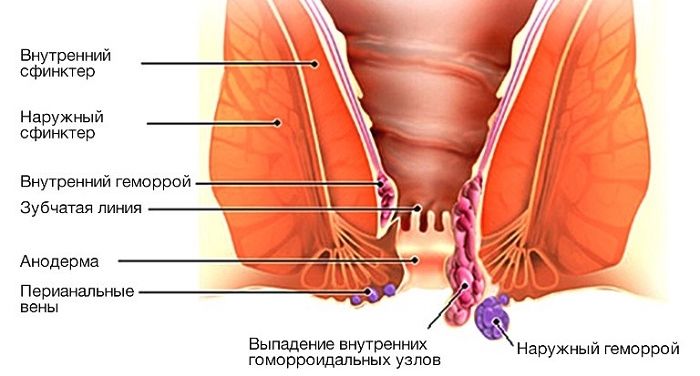 Геморрой при беременности кровит