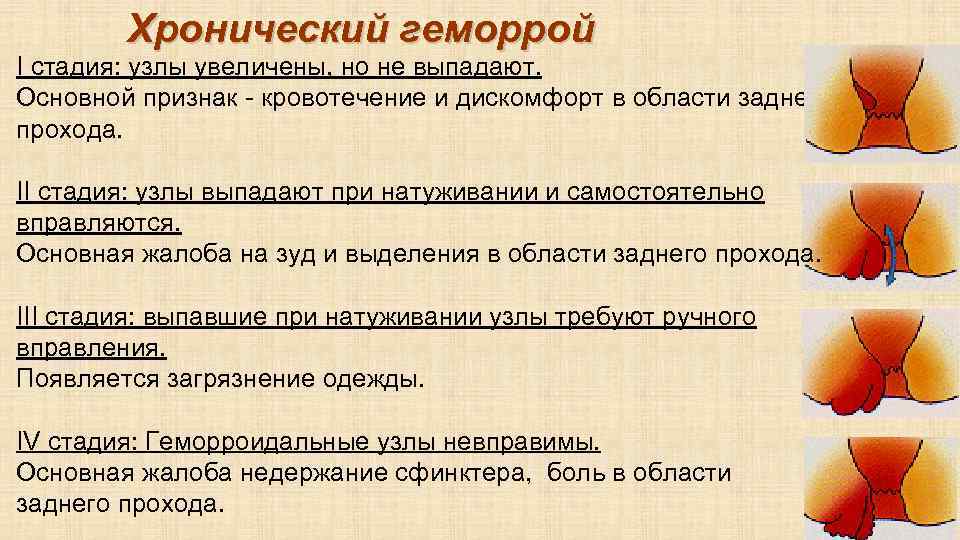 Острый геморрой схема лечения