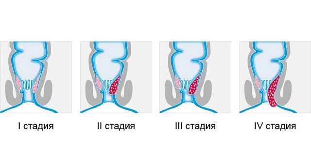 Наружный геморрой фото реальные