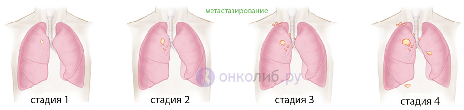 Стадии рака легкого картинки