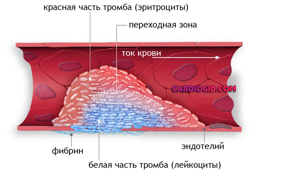 Схема образования сгустка в просвете сосуда