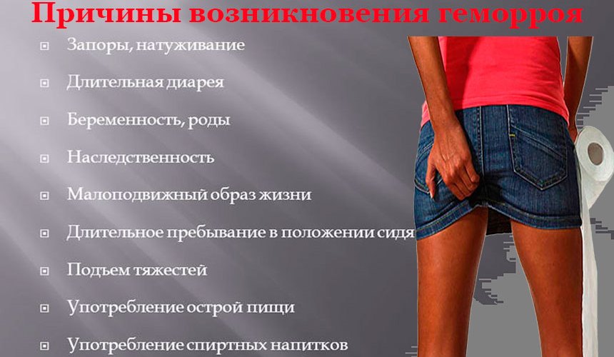 Стадии геморроя схема у женщин