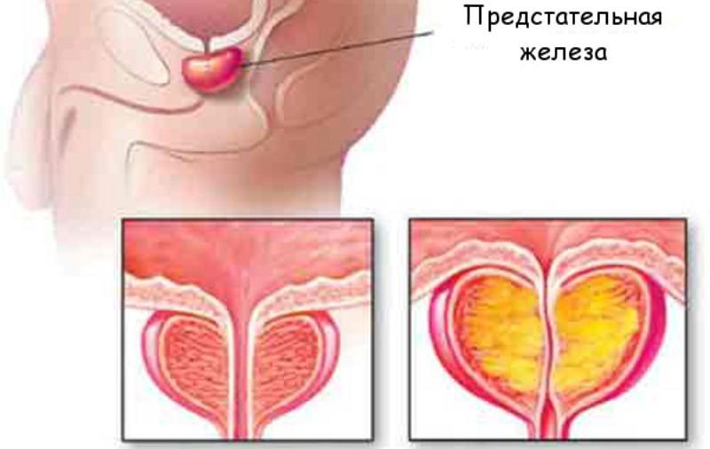 Воспаление предстательной железы. Воспаление железы предстательной железы. Хроническое воспаление предстательной железы. Простатит, аденома предстательной железы. Воспаленная предстательная железа.